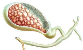 4 triệu chứng phố biến của bệnh sỏi mật