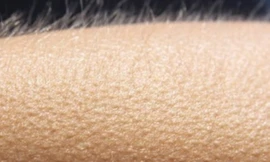 Phản ứng nổi da gà khi trời lạnh.