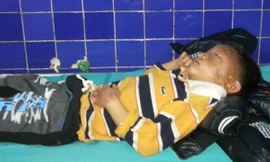 Bé trai bị bỏng mặt do mẹ dùng xăng mồi lửa. Ảnh: Long Nhật.