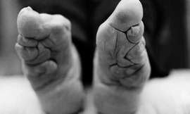 Những nhân chứng sống cuối cùng của tục bó chân