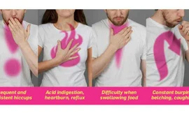 6 dấu hiệu nhận biết ung thư thực quản