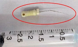Bé 5 tuổi nhập viện vì kim lấy tủy răng rơi vào phế quản
