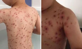 Mùa xuân, cẩn trọng bệnh thủy đậu vào mùa