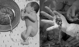 Bà bầu 18 tuổi ở Hà Nội sắp đẻ mà không biết