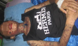 Bệnh nhân N.T.K.T nhập viện trong tình trạng bị bỏng rộp toàn thân, li bì, sốt cao, tinh thần rối loạn và được chẩn đoán bị hội chứng Liell, nghĩ nhiều đến dị ứng thuốc.