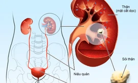 Ngăn ngừa biến chứng khó lường của sỏi tiết niệu