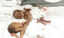 Chăm sóc trẻ sinh non cần một chế độ đặc biệt. (Ảnh cặp song sinh sinh non 500gr vừa được Bệnh viện Phụ sản Trung ương nuôi thành công).