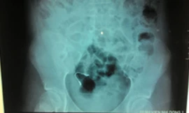 Cọng kẽm niềng răng mà bệnh nhi nuốt vào bụng. Ảnh: BV cung cấp