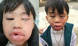 Hình ảnh cháu bé bị sưng môi sau khi ăn kẹo. Ảnh: GĐCC.