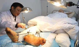 Người đàn ông có hai “bàn chân phải"