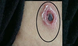 Vết loét to ở vùng bẹn do con mò cắn của bệnh nhân NTT nhưng ông và bác sĩ tuyến dưới không biết. Ảnh: TÙNG SƠN 