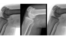 Cân nặng của một người khi nhỏ thực sự tác động tới viêm khớp hông, khớp gối nhiều hơn so với cân nặng khi trưởng thành.