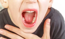 Viêm VA và các dấu hiệu trở nặng