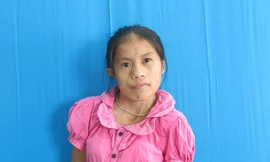 Vi Thị Phú mắc dị tật xương hàm, khớp cổ lệch, vẹo cột sống và dị tật tai