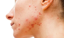 Khi bị mụn trứng cá, cơ thể đang cố gắng cảnh báo về rối loạn nội tiết hoặc rối loạn tiêu hóa.