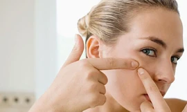 Không nên nặn mụn (ảnh minh họa)