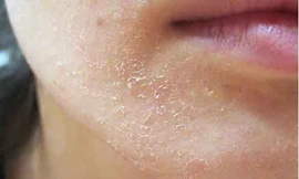 Lột trắng da làm đẹp không đúng cách coi chừng gây hại cho da.