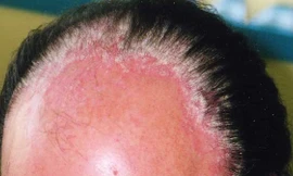 Vẩy nến da đầu