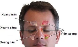 6 biến chứng nguy hiểm của bệnh viêm xoang