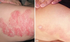 Hướng điều trị mới cho bệnh vẩy nến