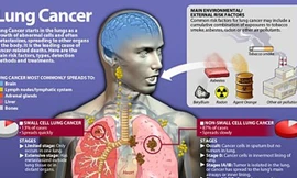 Thuốc lá – sát thủ số 1 gây ung thư phổi, lấy đi sinh mạng 1,8 triệu người mỗi năm