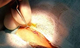 Bác sĩ đang gắp con giun ra khỏi mắt bệnh nhân nữ. Ảnh: Aster Hospital.