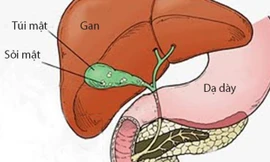 'Kẻ thù' của bệnh sỏi mật