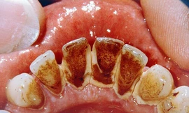 Bí kíp tự lấy cao răng hiệu quả ngay tại nhà