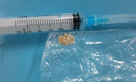 Miếng mít non được gắp ra từ phế quản của trẻ. 