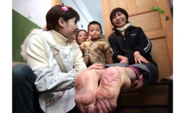 Cô gái có bàn chân quay ngược về phía sau 