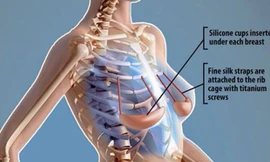 Áo nâng ngực dưới da cấu tạo gồm một quả áo ngực bằng silicon loại tốt, ở dạng rắn đặt dưới mô vú và các dây đeo bằng lụa gắn cố định vào xương sườn của bệnh nhân để nâng đỡ bầu ngực. Ảnh: Daily Mail