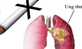 Hút thuốc lá là một trong những nguyên nhân chính gây nên bệnh ưng thư