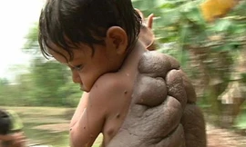 Didier Montalvo và khối u khổng lồ sau lưng