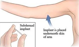Que cấy tránh thai được cấy vào dưới da phía mặt trong cánh tay không thuận.