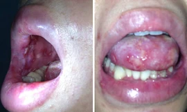 Bệnh nhân bị lở loét nhiều ở vùng môi, lưỡi và niêm mạc má (ảnh do BS cung cấp)