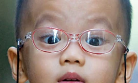 Khắc phục loạn thị cho con không cần đeo kính