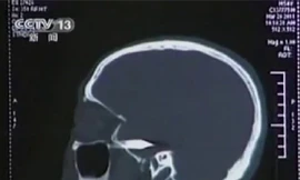 Nhờ chụp não, các bác sĩ đã phát hiện ra viên đạn găm trong đầu nạn nhân