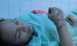 Sơ cứu khi bị đứt lìa tay, chân