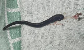 Gắp vắt sống dài gần 7cm trong mũi người phụ nữ