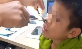 Gắp vắt dài 8cm 'ngoe nguẩy' trong mũi nam thiếu niên