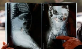 Hãi hùng phát hiện 12 chiếc kim trong người bé gái