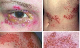 Sốt mò, căn bệnh bị lãng quên đã trở lại