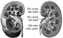 Sỏi thận - Ngăn ngừa tái phát trong điều trị