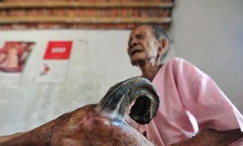 Nỗi khổ của cụ bà 97 tuổi mọc sừng 20 cm ở chân