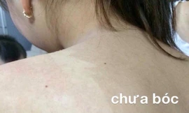 Nguy cơ ung thư khi lột da như rắn để làm trắng