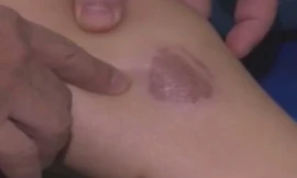 Bị bỏng bô xe máy, xử lý và điều trị thế nào?