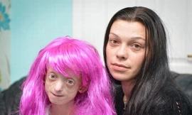 Bé gái 11 tuổi già như bà cụ 80 