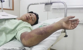 Bệnh nhân Hoàng Minh Quang đang được điều trị tại khoa Hồi sức cấp cứu, bệnh viện TW Huế.