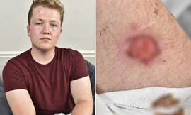 Một người dùng bị bỏng do iPhone 5 nóng bất thường