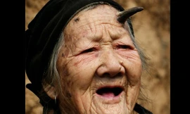 10 căn bệnh quái dị và đáng sợ nhất trên thế giới